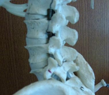 Spine model showing lateral view. Lumbar spinous p