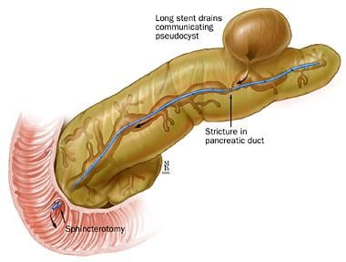 Pancreatic stent placement for pseudocyst drainage