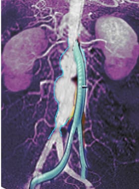 Image shows bypass of aneurysmal portion of aorta.