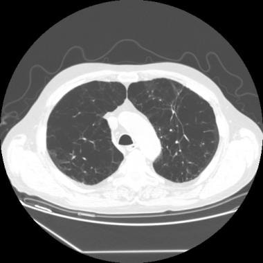 CT scan of chest in patient with emphysema from sm
