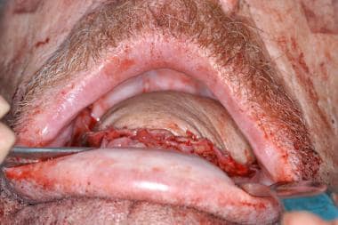 Total glossectomy reconstruction with anterolatera