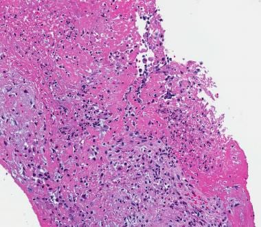 bacterial endocarditis histology