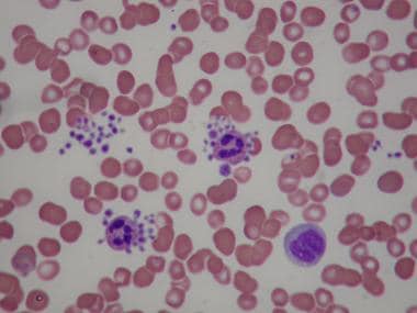 Spurious thrombocytopenia. Peripheral smear from a