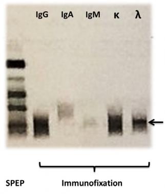 On the left a serum protein electrophoresis (SPEP)