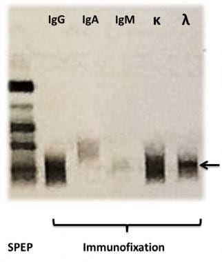 Immunofixation: Interpretation, Collection Panels