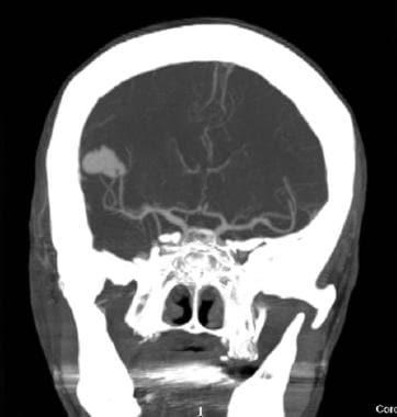 Coronal CT angiography shows large, irregularly sh