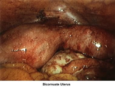 Infertility. Bicornuate uterus. Image courtesy of 