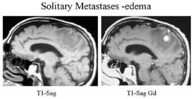 Sagittal T1-weighted precontrast and postcontrast 