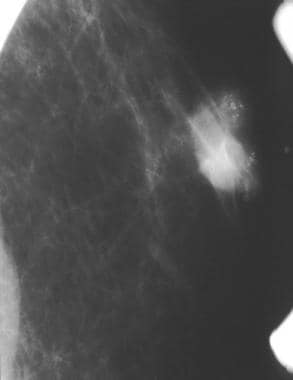 A partially circumscribed retroareolar mass in a m