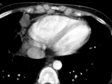 Restrictive cardiomyopathy. Axial contrast-enhance