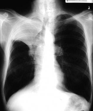 Right upper lobe collapse. This chest radiograph s