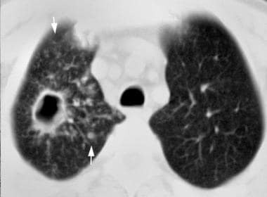 A middle-aged man presents with a cough and fever 