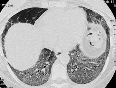High-resolution CT of biopsy-proven nonspecific in