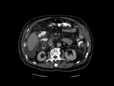 Fifth image in a series of enhanced CT scans in th