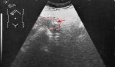 Axial sonogram through the pancreas shows a bulbou