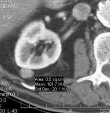 Case 4. Renal cell carcinoma. Contrast-enhanced de