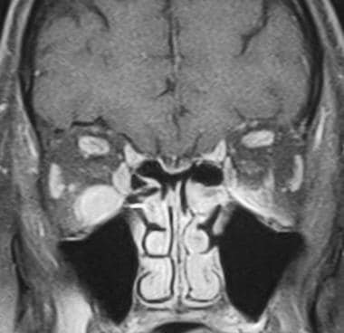 MRI coronal section of the same patient as in the 