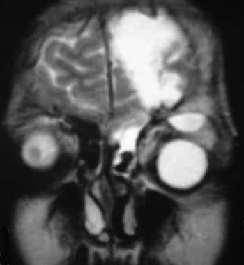 Ethmoid sinusitis with intracranial extension and 