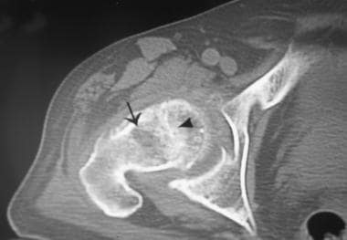 Axial computed tomographh scan of a patient with a