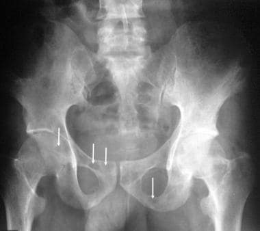 Radiograph of the pelvis (same patient as in the p