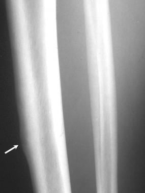 Plain radiograph in a 25-year-old man with cortica