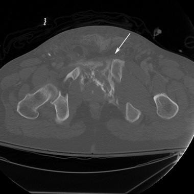Fall from overpass. CT pelvis demonstrates widenin