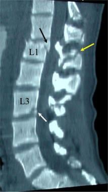 Lumbar spine trauma. A 35-year-old man presented t