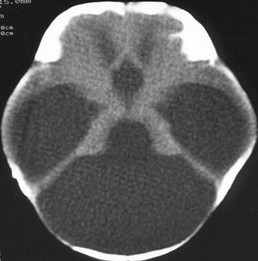 A CT scan depicting Dandy-Walker malformation. 