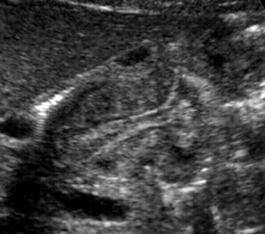 Longitudinal ultrasonogram in a patient with hyper