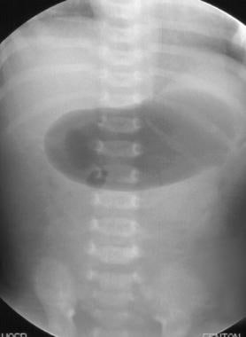 Supine radiograph in a newborn with midgut volvulu