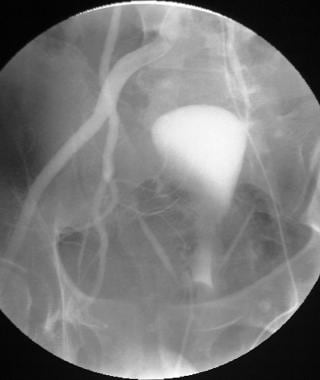 Unsubtracted right iliac angiogram in a young woma
