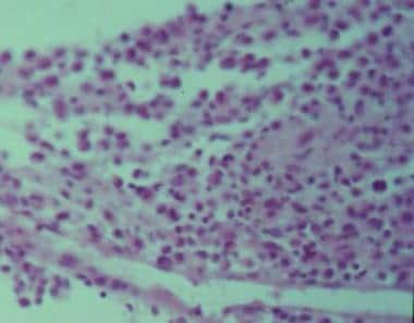 Histology of eosinophilic granuloma. 