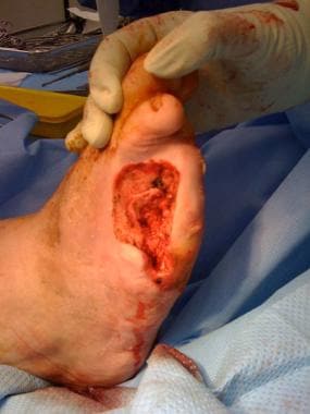 Lateral two toes amputated. Note alternative techn