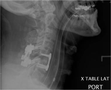 Postoperative lateral radiograph shows anterior an