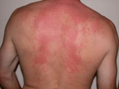 An example of a typical histamine toxicity rash, i