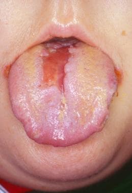 Herpes simplex virus ulceration on the dorsal surf