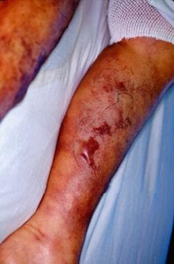 Calciphylaxis may manifest as rapidly progressive,
