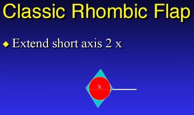 Classic rhombic flap. 