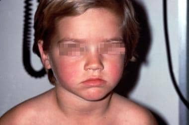 Fifth Disease (Erythema Infectiosum): Symptoms, Causes & Treatment