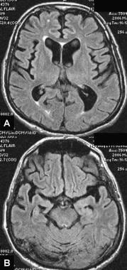 Axial brain MRI of a patient with progressive trem