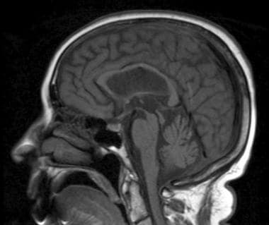 Sagittal T1-weighted image shows atrophy of midbra