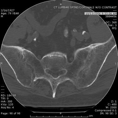 CT scan of the pelvis in a patient with AS showing