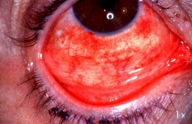 Follicular conjunctivitis and subconjunctival hemo