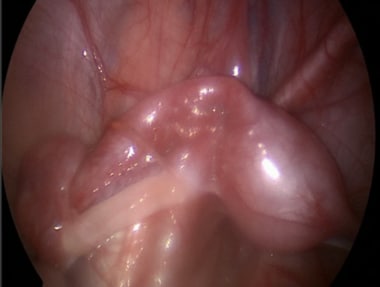 Intraoperative finding of uterus, fallopian tube, 