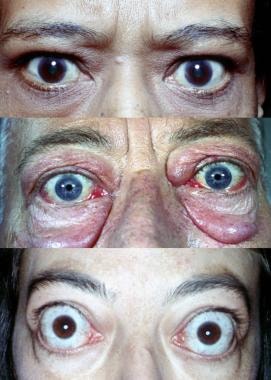 graves disease ophthalmopathy manifestations epidemiology background varying degrees pathophysiology hyperthyroidism pi named