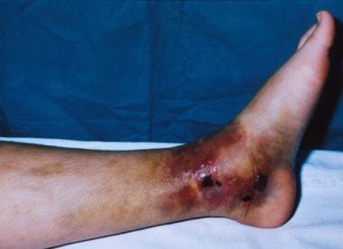 CRUSH INJURY FOOT, LOWER LIMB INJURIES AND LIMB SALVAGE: DEGLOVING