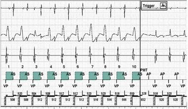 Pacemaker-Mediated Tachycardia. Example of a pacem