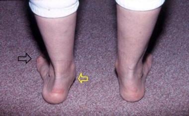 Pes planus (flatfoot). Too-many-toes sign. Three l