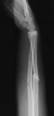 Lateral radiograph of displaced midshaft both-bone