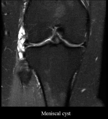 Firm lesion on the lateral thigh